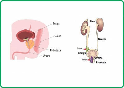 IMAGENS PRÓSTATA2